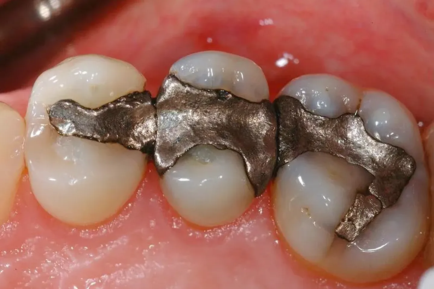 Amalgam Fillings