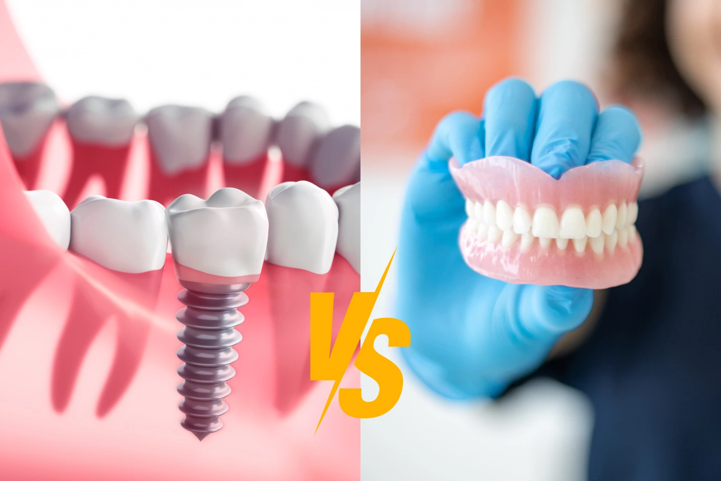Dental Implants vs. Dentures