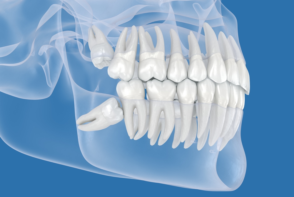 Wisdom Tooth Extractions in Hoffman Estates, IL