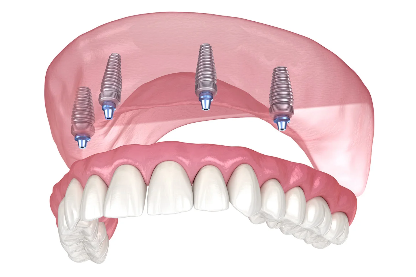 A Brief Comparison Between Implant Supported Dentures And Traditional Dentures - Rockville Family Dental