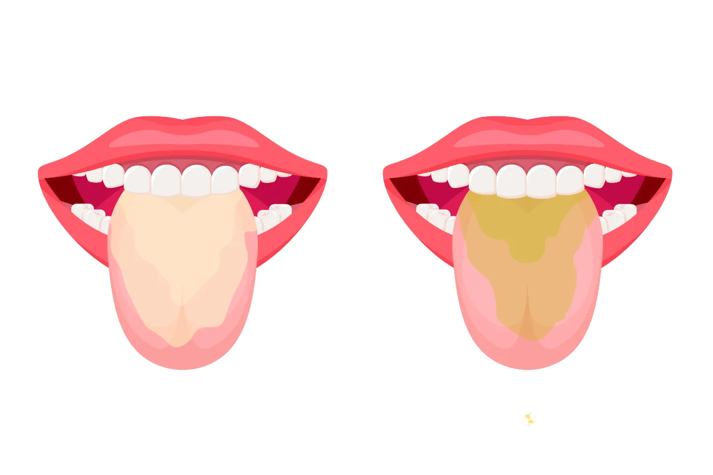 You Need to Know About Oral Thrush:Here's Why?