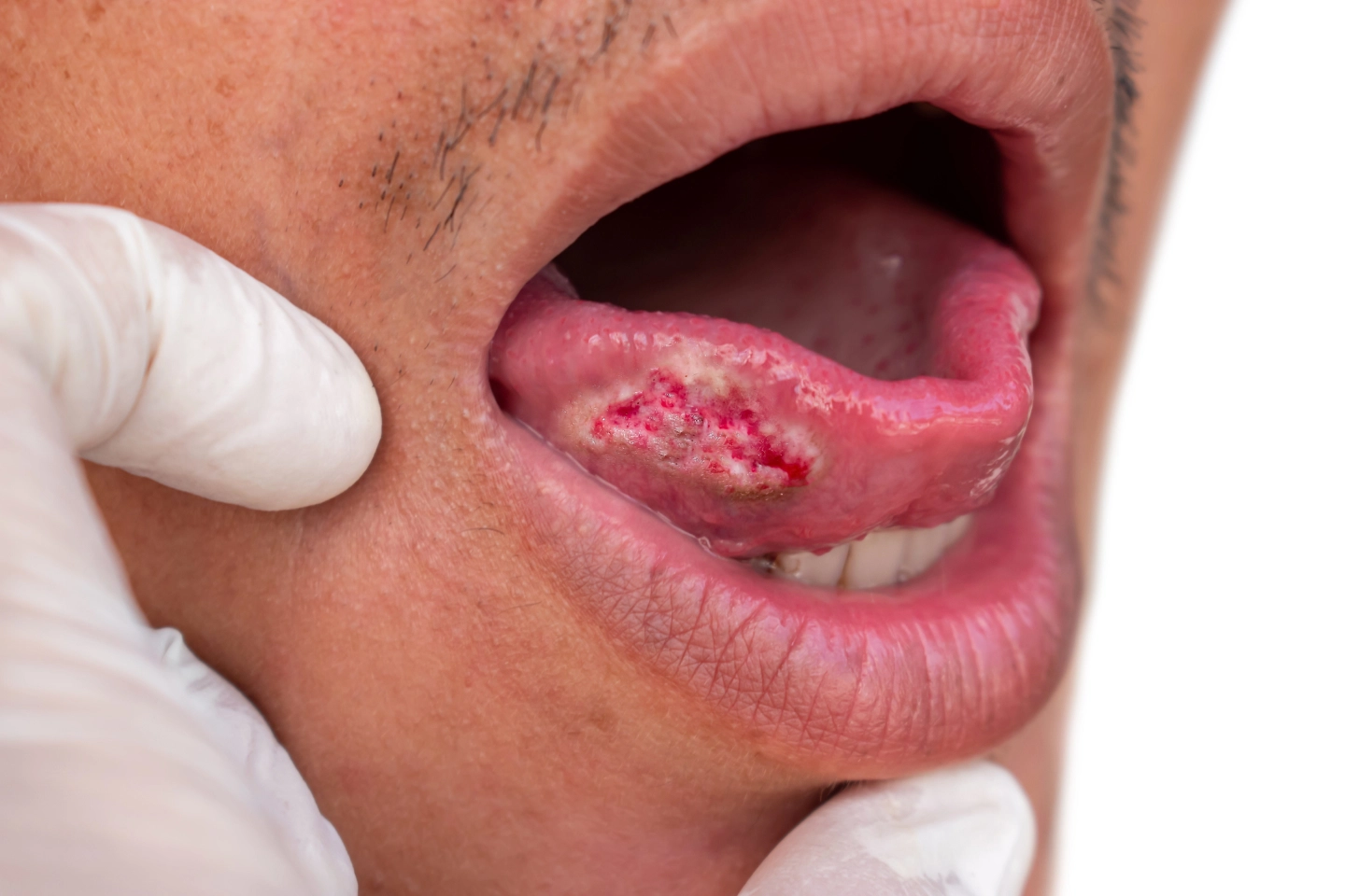 When to Get an Oral Cancer Screening From Your Family Dentist