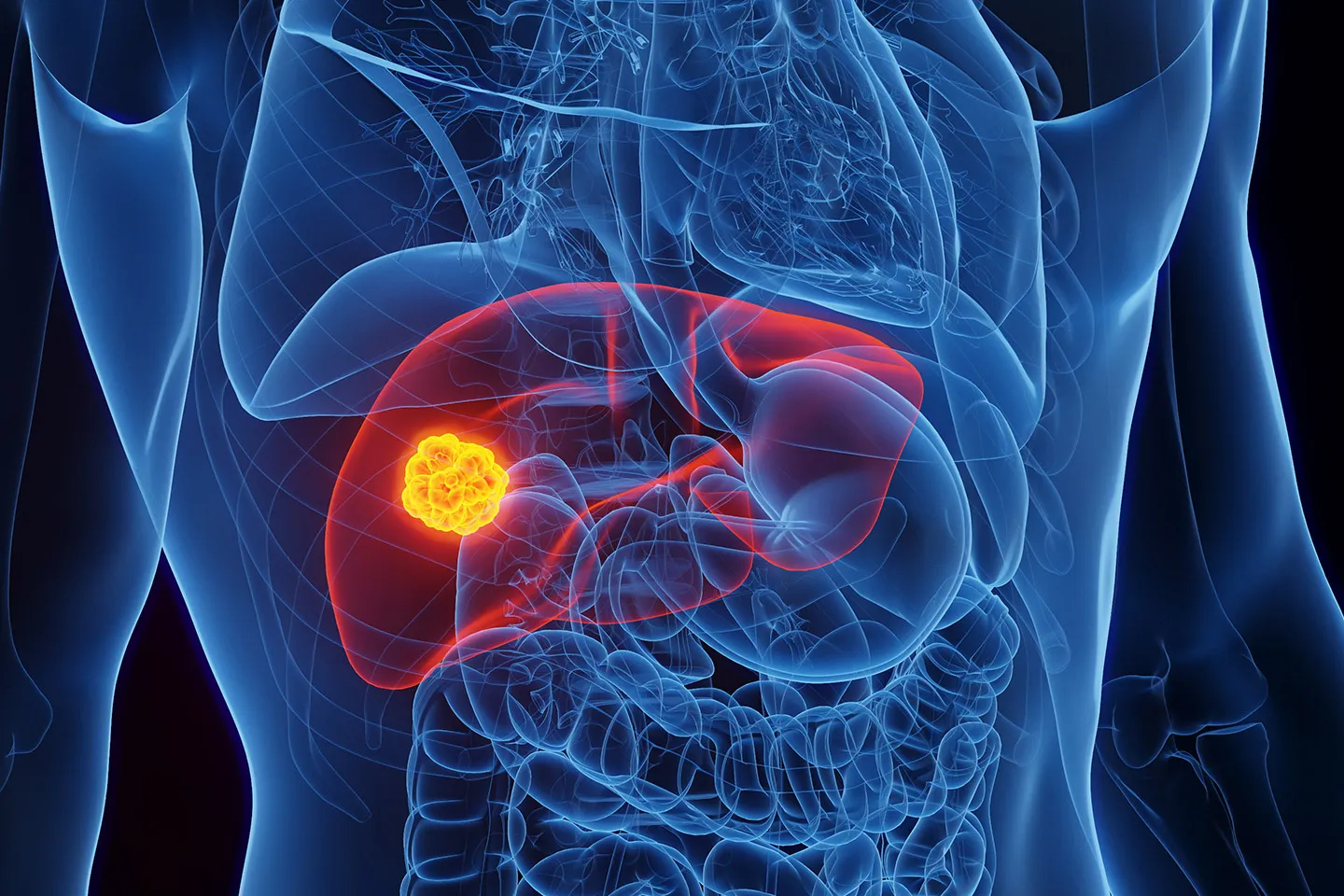 Understanding Hepatic Cysts