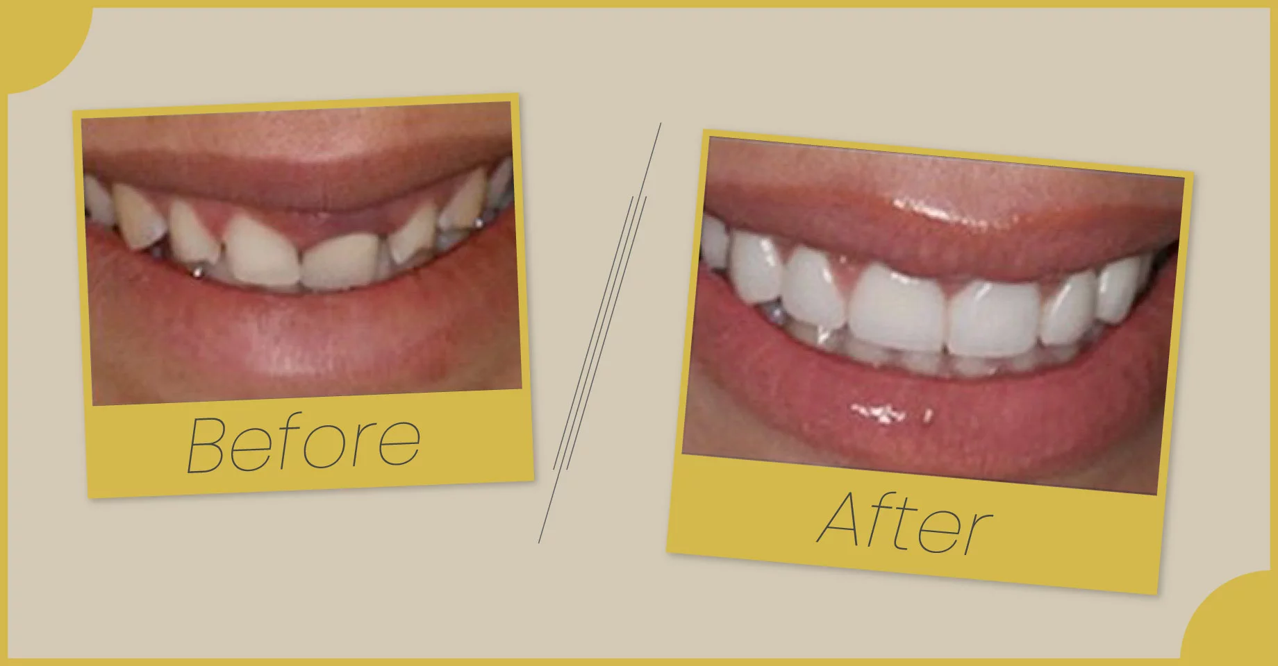 Before and After Images of Dental Care at Smile Saver Dental