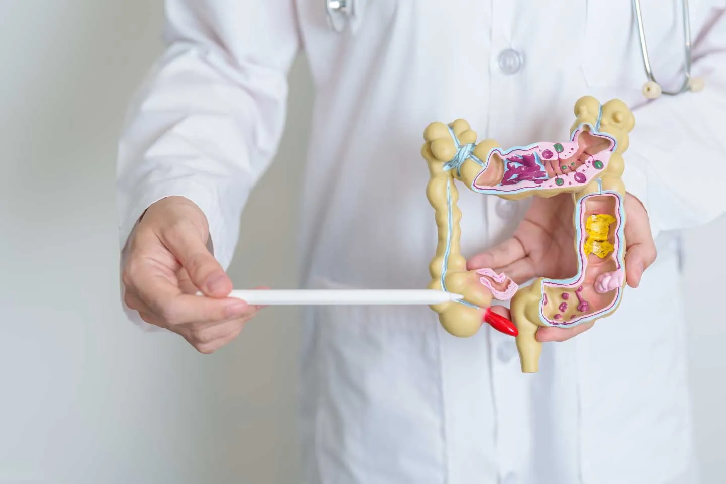 Surgical Treatment of Diverticulitis: When Is Laparoscopy the Best Option?