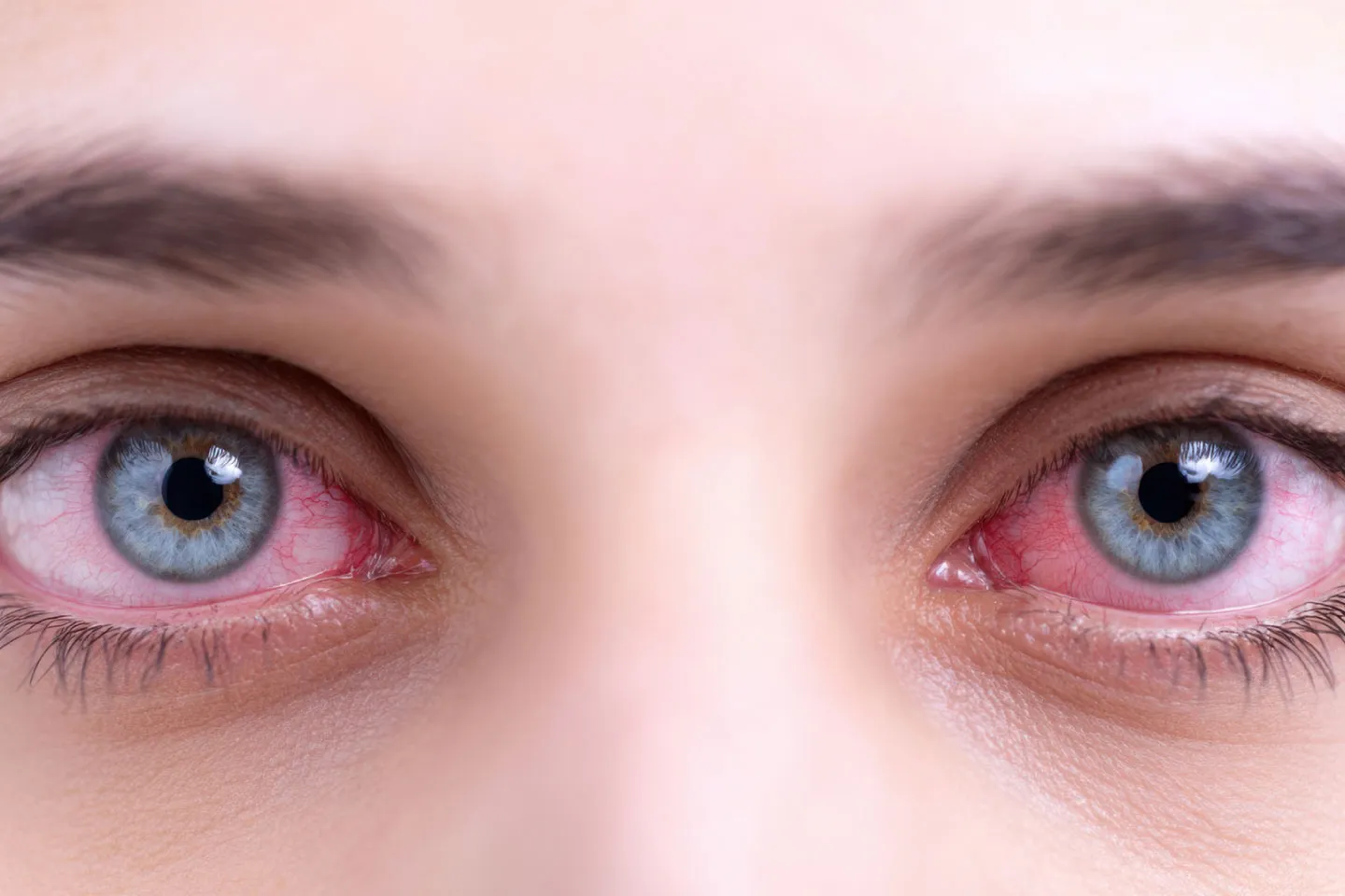 Bloodshot Eyes — Should You Be Concerned?