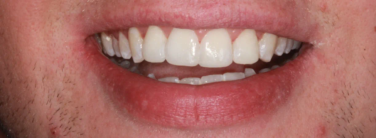 Teeth Whitening