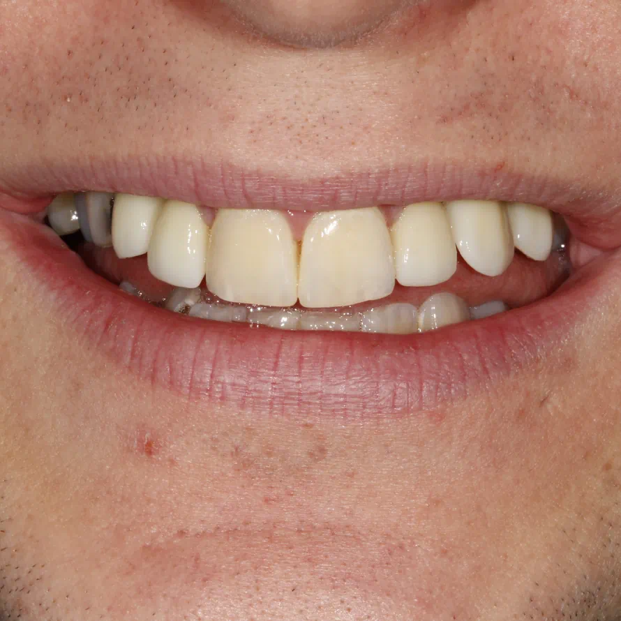 Missing Teeth