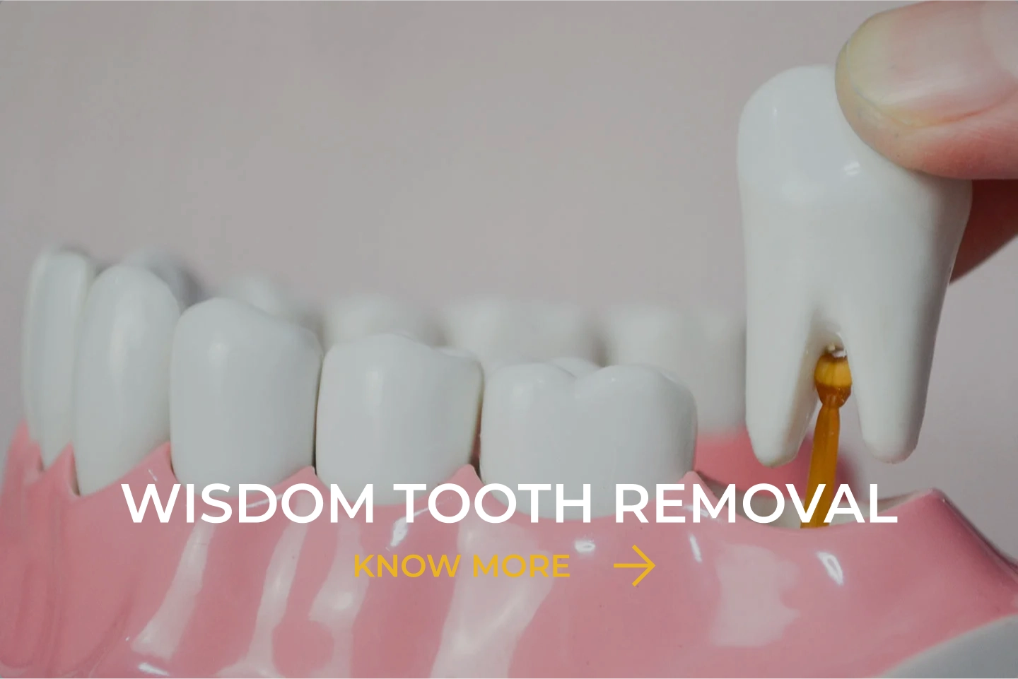 Wisdom Tooth Removal