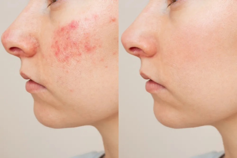 Rosacea Treatment & Skincare Solutions for Radiant Skin