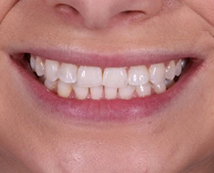 Composite Bonding