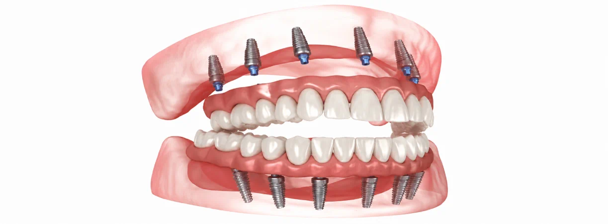 Full Mouth Reconstruction