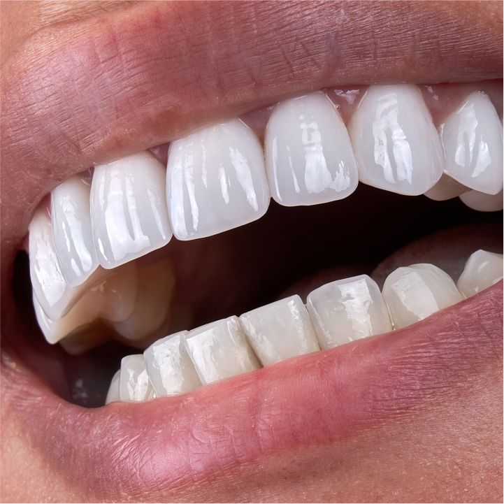 Dental Implants