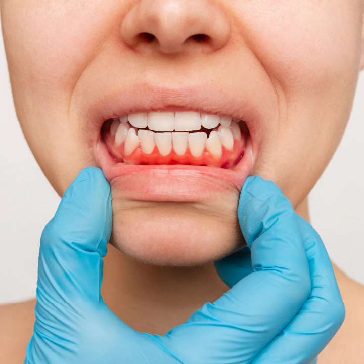 Are Your Gums Bleeding? This Could Be Why