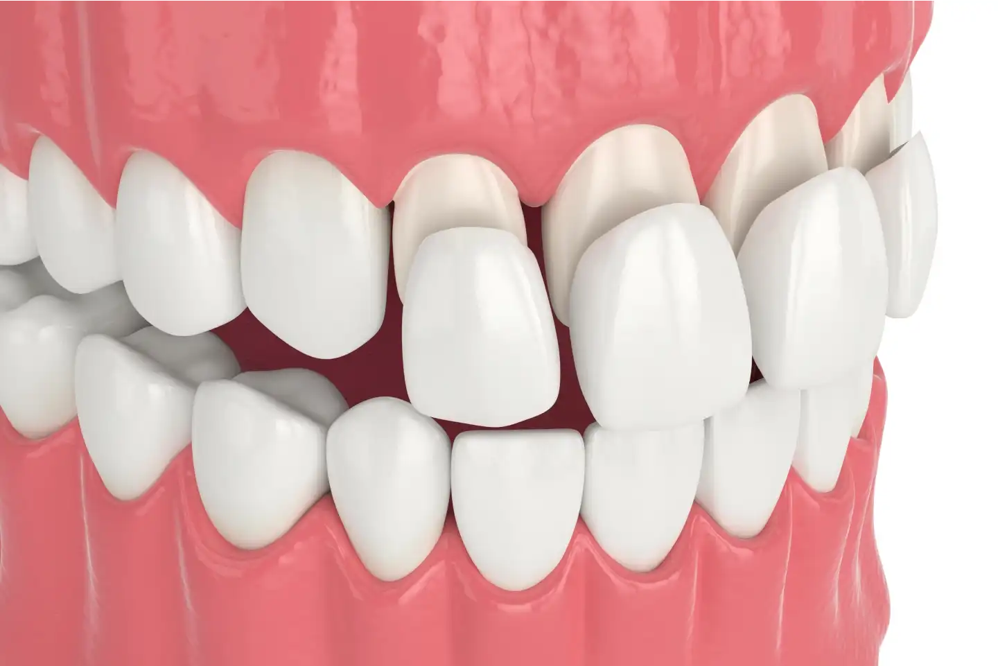 Veneers in Schaumburg, IL | Porcelain veneers Schaumburg