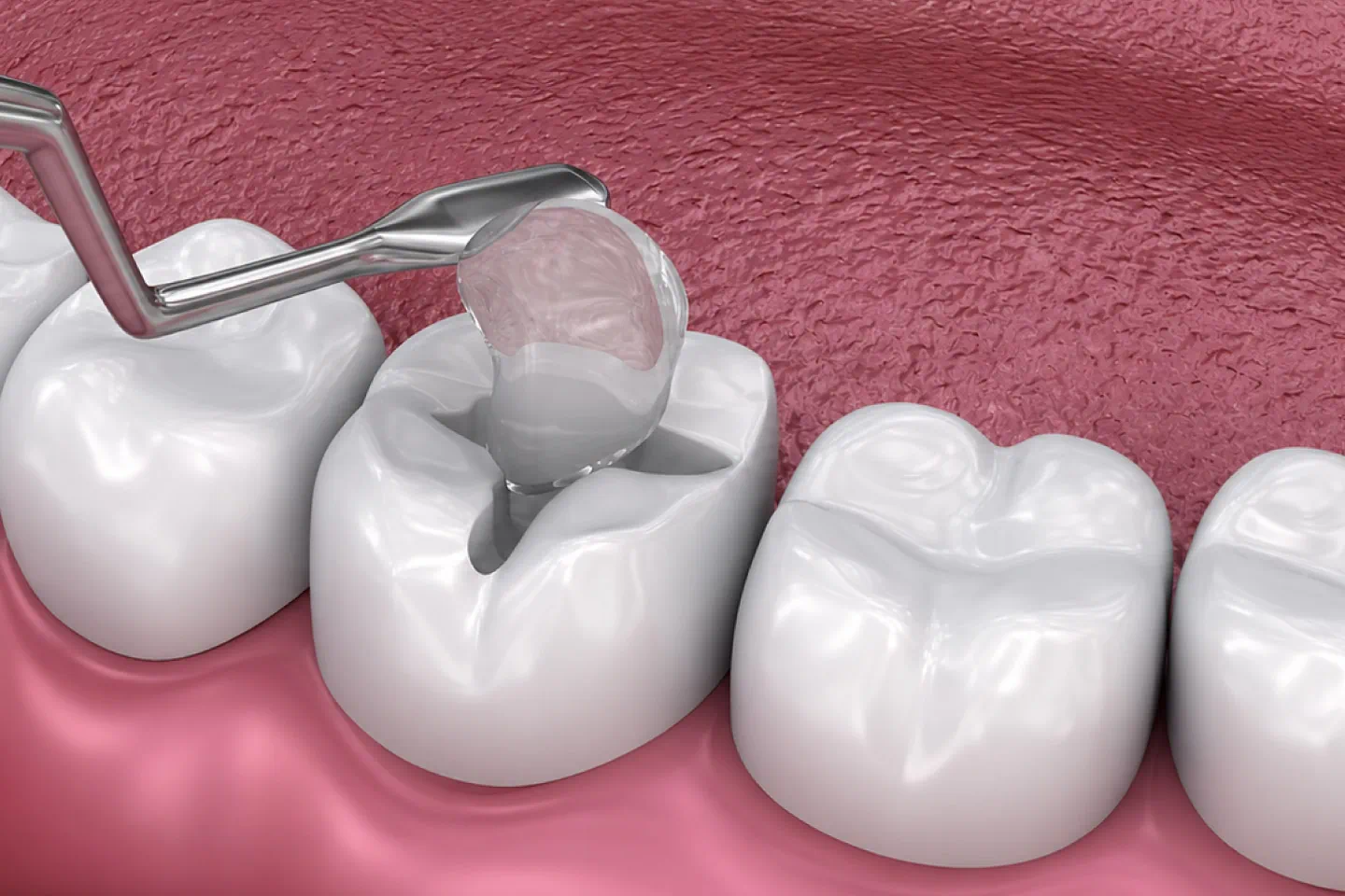 Dental Fillings