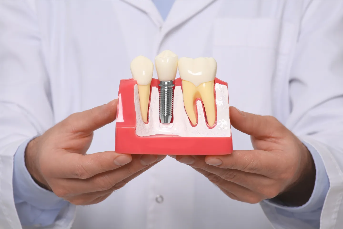 What Questions to Ask About Dental Implants | Pingree Grove, IL