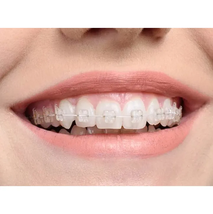 Clear braces
