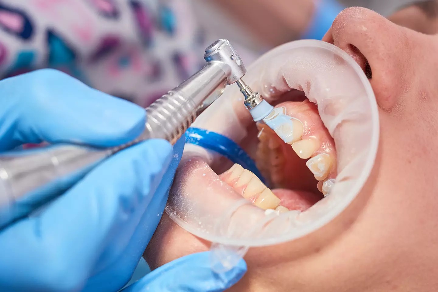 Prophylaxis (Teeth Cleaning)