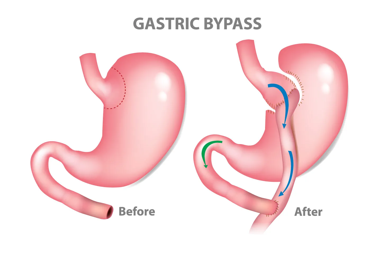 Exploring Mini Gastric Bypass