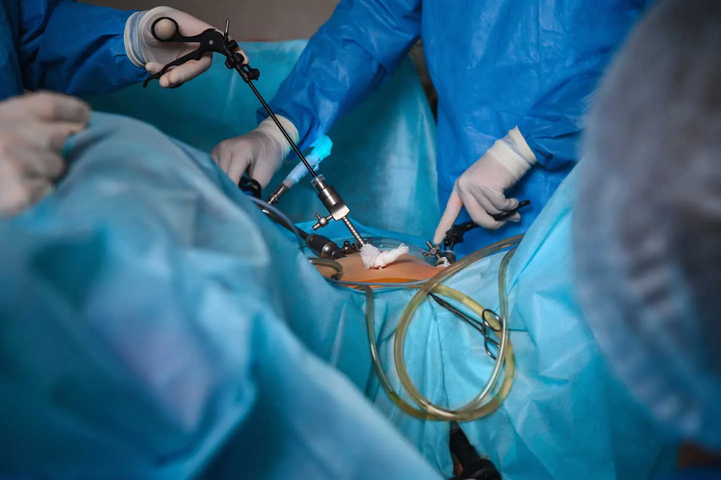 Liver Laparoscopy for Biopsy: Procedure, Purpose, and Benefits