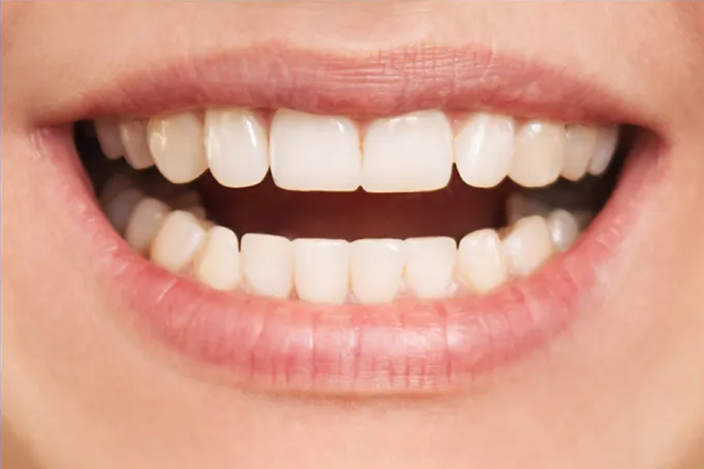 Straighter and aligned teeth after Invisalign® clear aligners