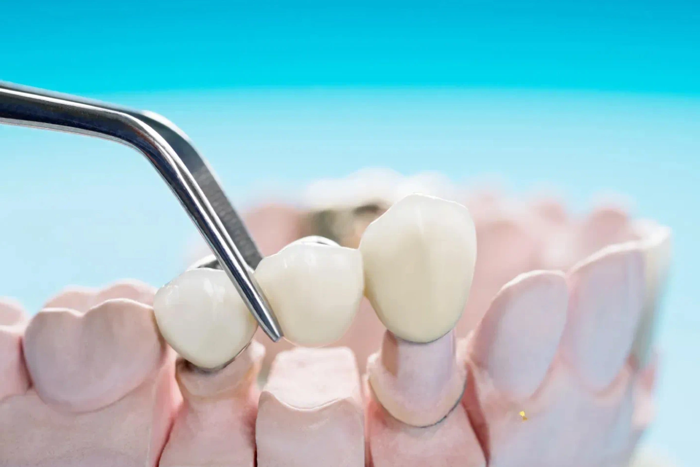 How Long Do Dental Bridges Last? | St Andrews Dental Biggleswade