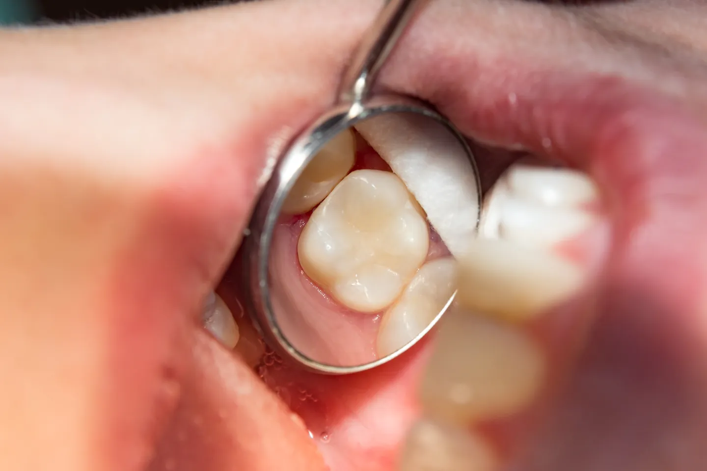 Tooth-Colored Fillings: A Modern Solution for Cavities