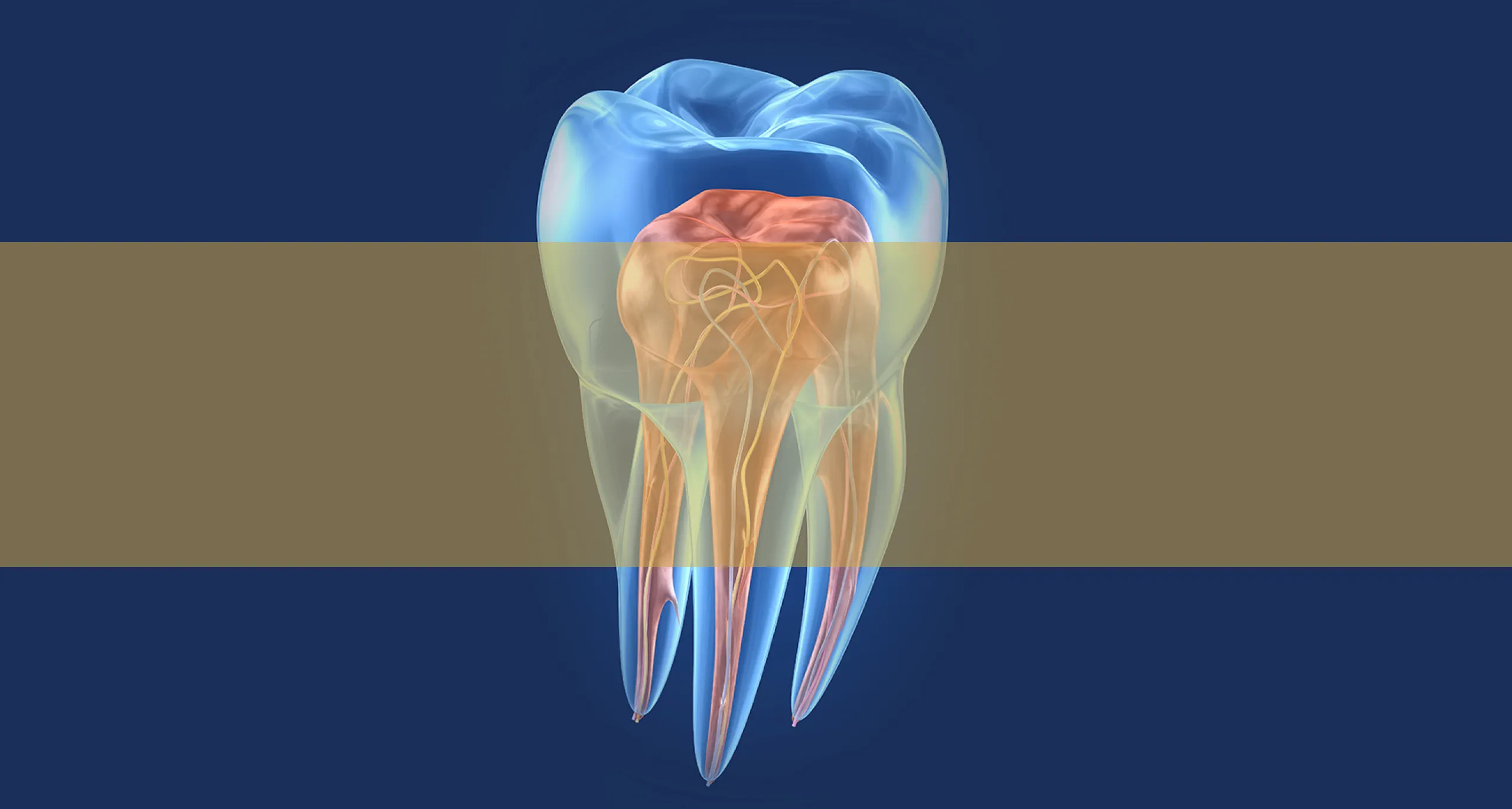 Root Canal