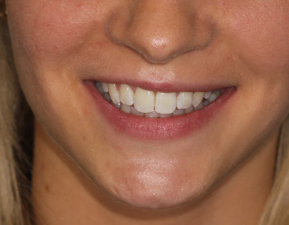 6 Month Smiles