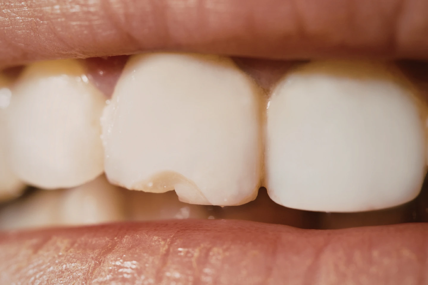 How Do Dentists Fix a Chipped Tooth in San Jose, CA? | Varni Dental