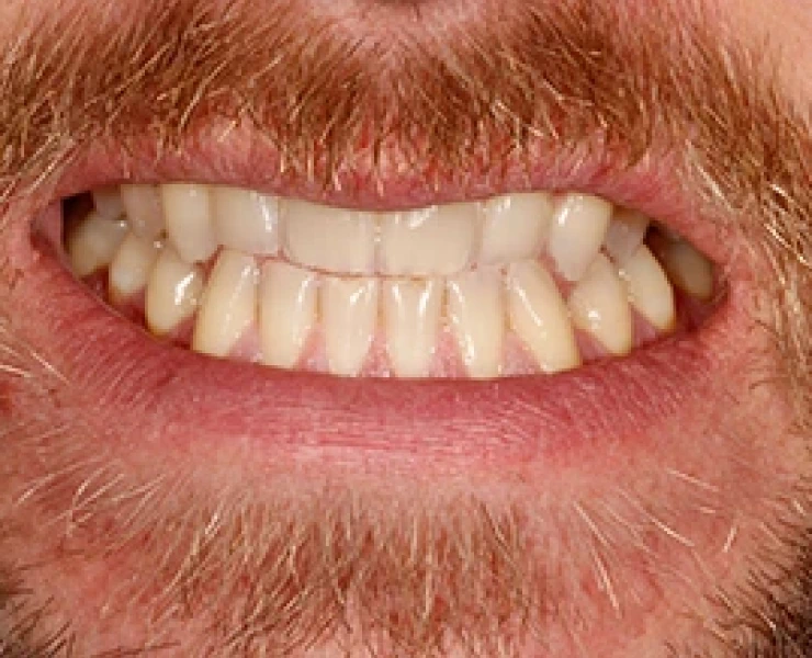 Enlighten Teeth
