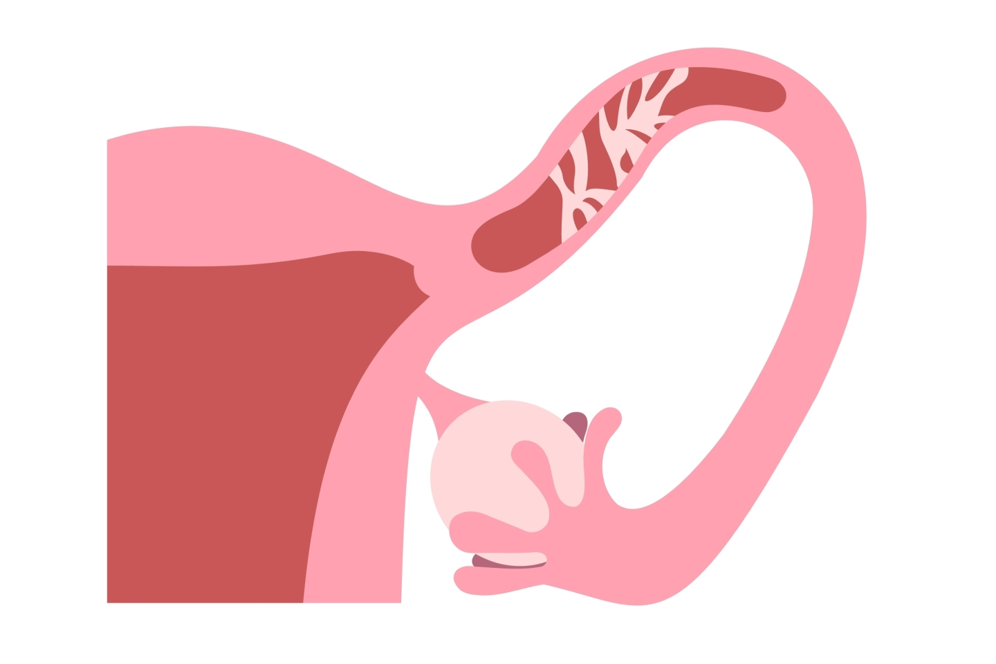 Laparoscopic Recanaization.