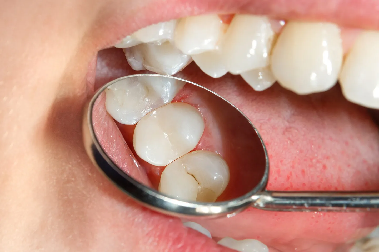 Dental Sealants - Rockville Family Dental