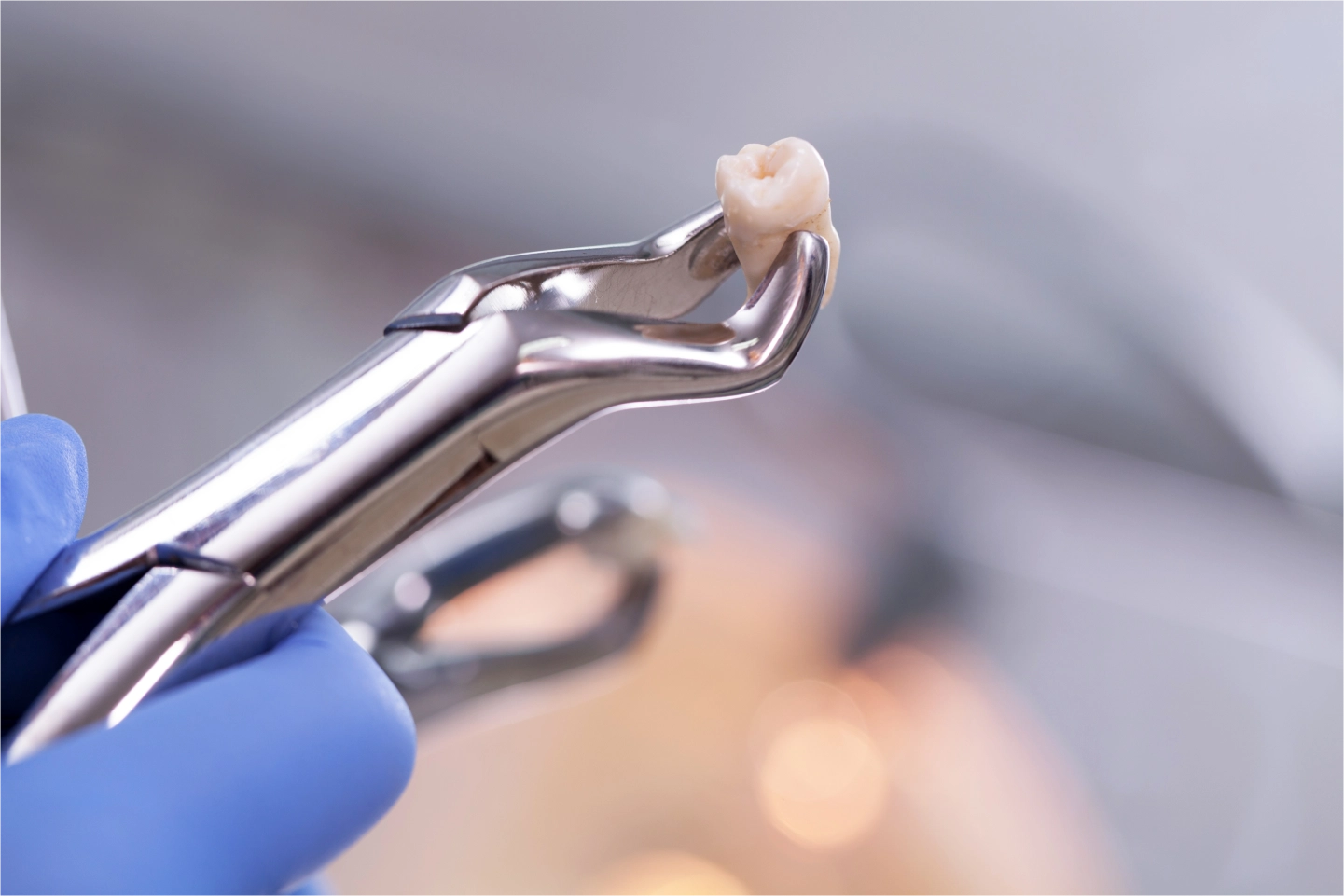 Tooth Extraction Services