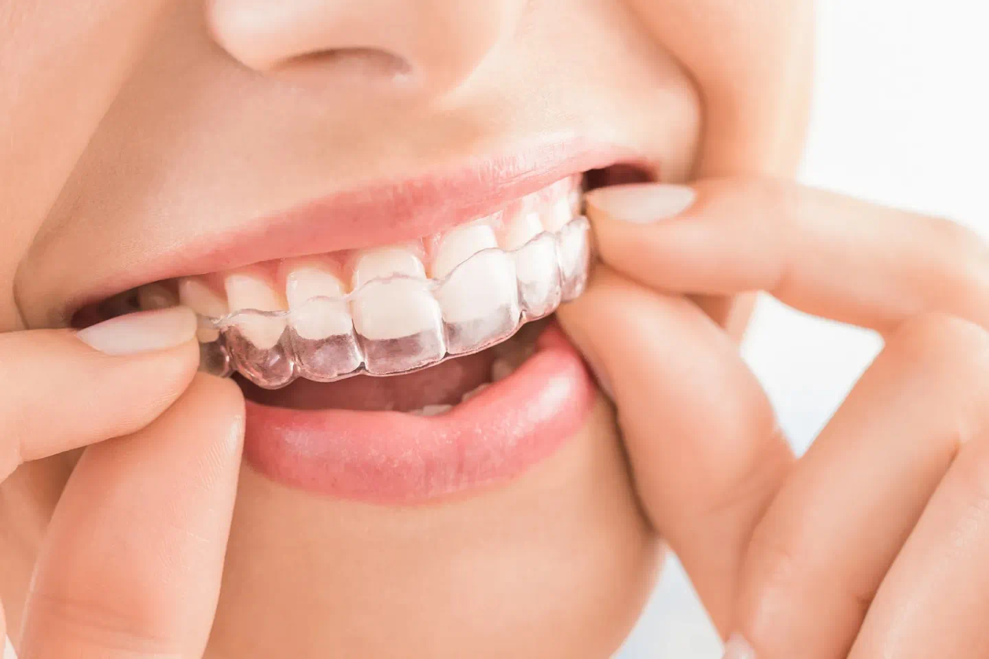 Invisalign Aligner Care Tips for a Cleaner, Healthier Smile