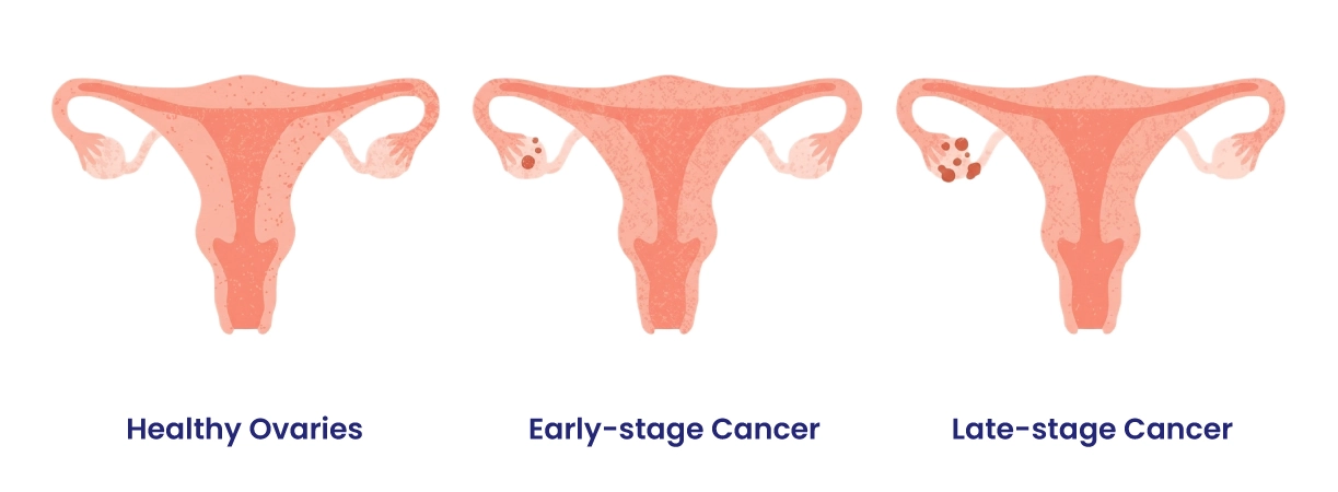 Early Signs of Ovarian Cancer