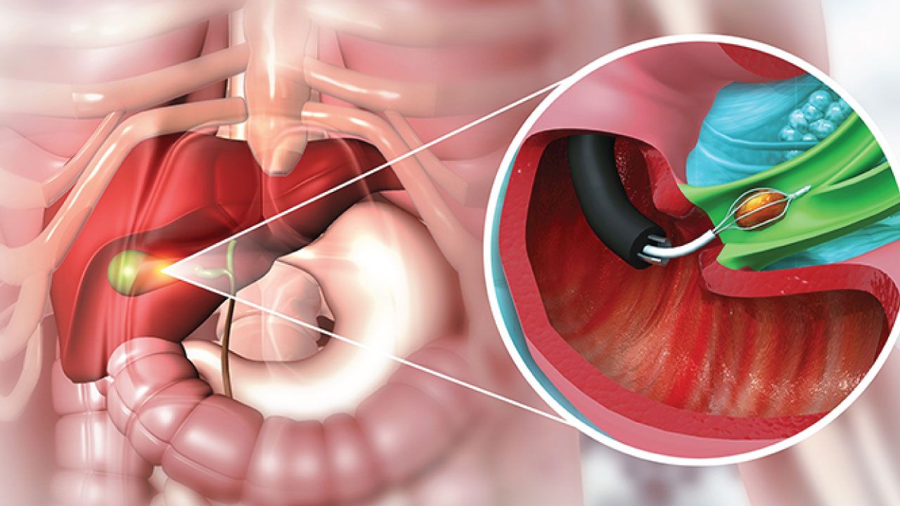 Bile Duct Medical Illustration With Endoscopic Tool