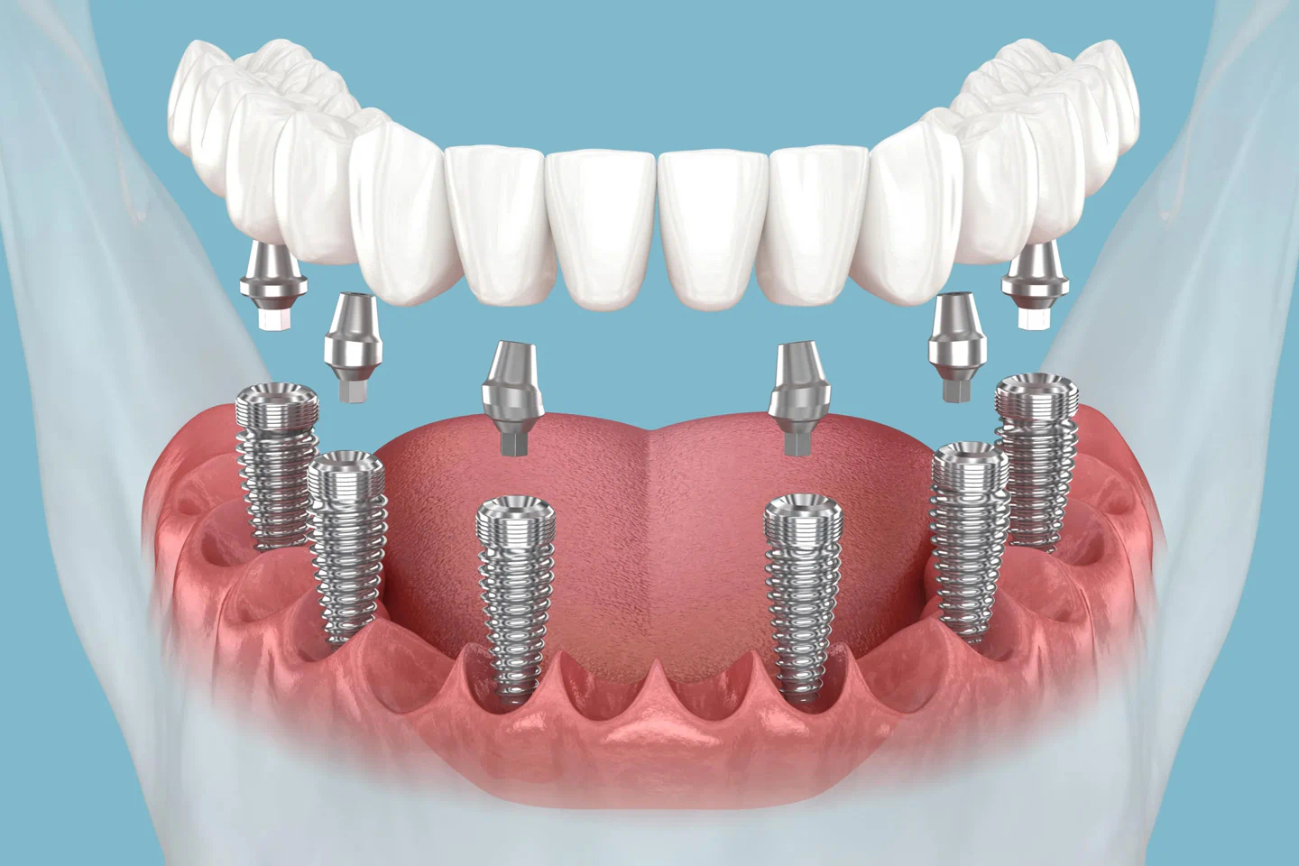 dental implants covered by Guardian Dental