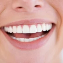 Transform Your Smile with Porcelain Veneers in Leicester