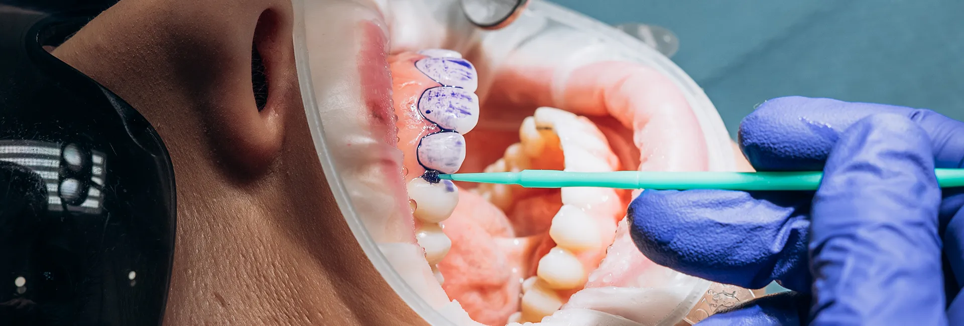 Fluoride Treatment