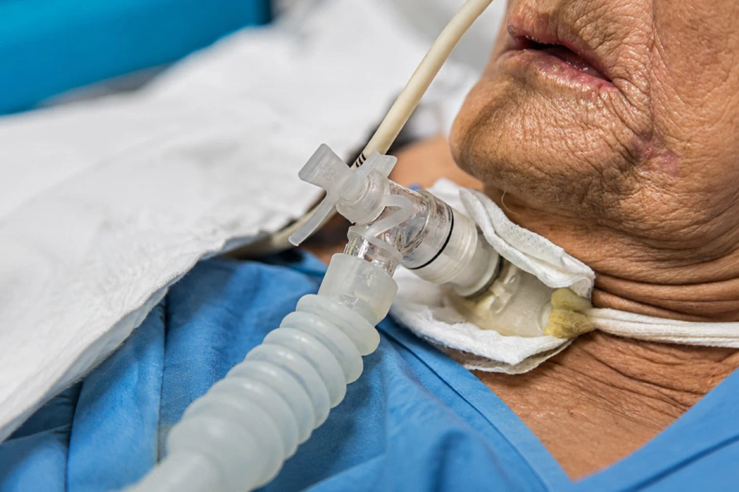 Tracheostomy