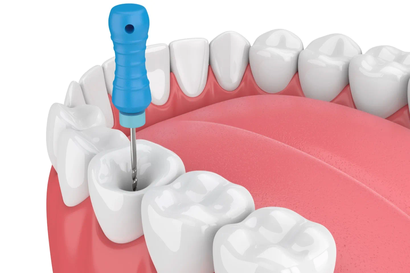 Root Canal Treatment