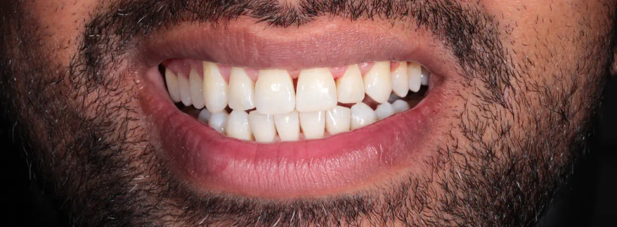 Invisalign