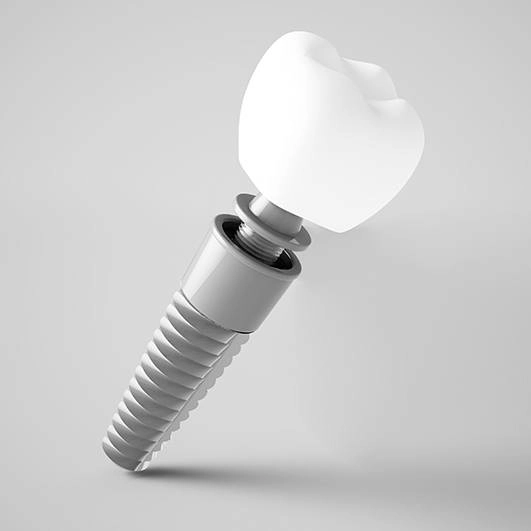 How Much Does a Single Tooth Implant cost in UK?