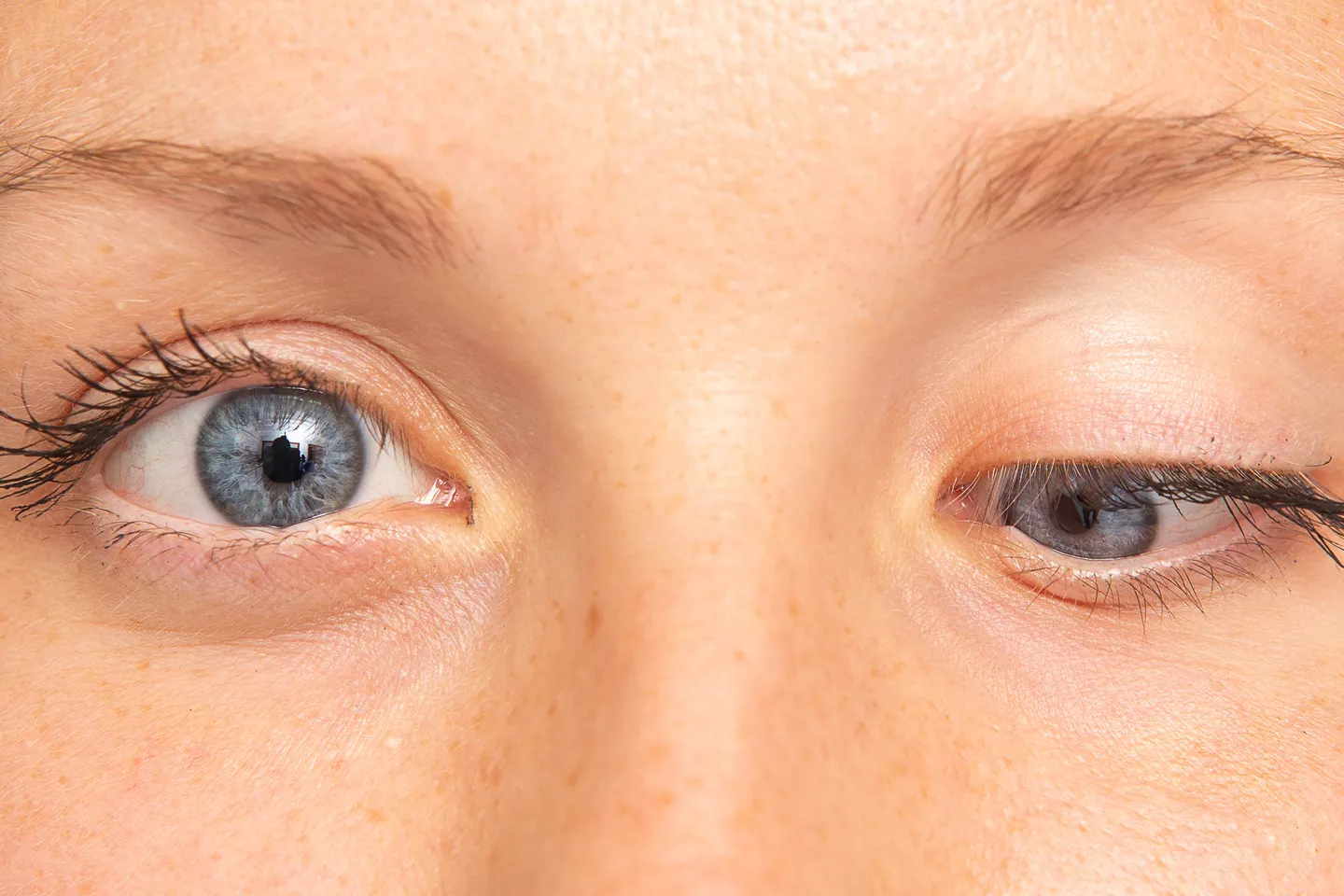 eyelid-disorders.image