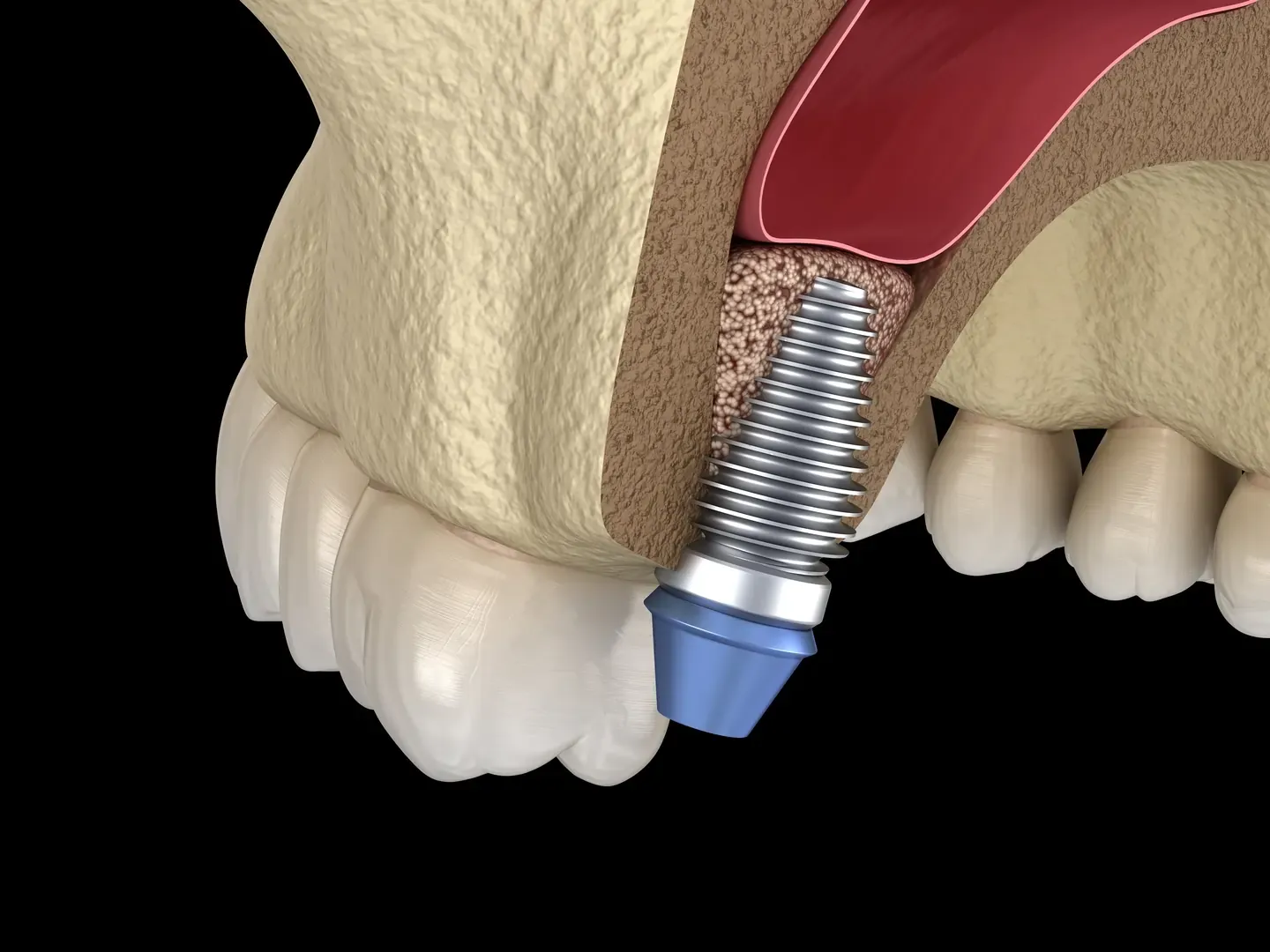 Dental implant specialist explaining sinus lift surgery and upper jaw implant planning to a patient