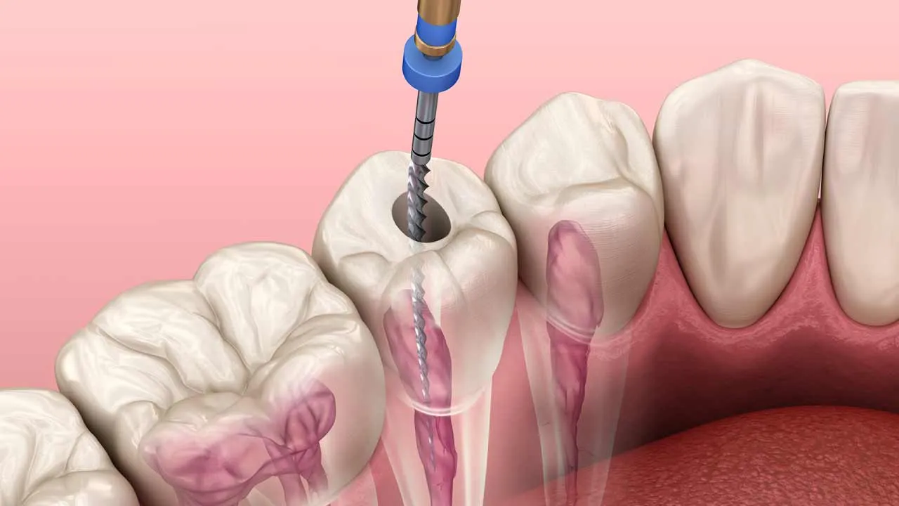 Root canal Images