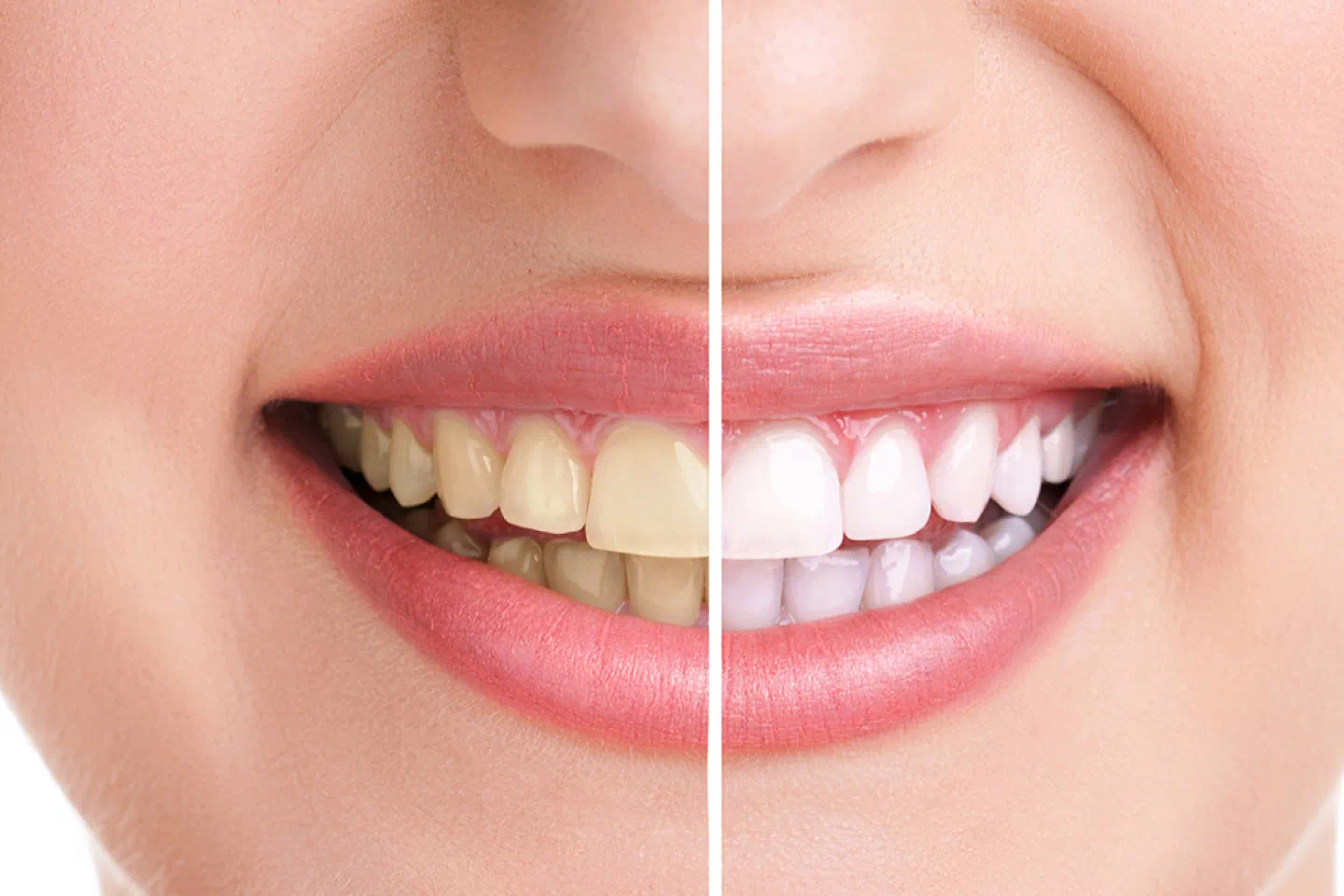 Teeth Whitening