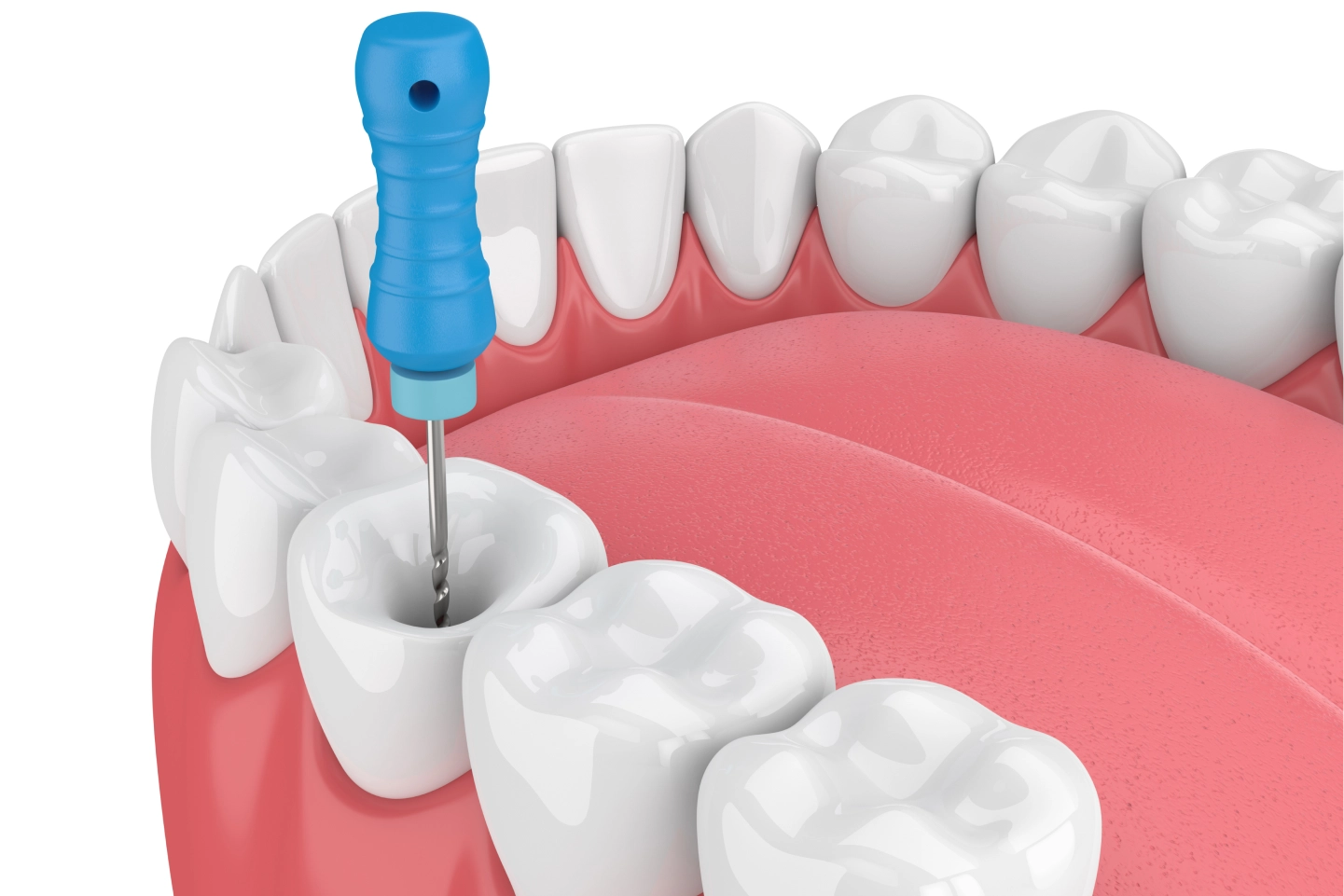 Root Canal Treatment in Ware, MA